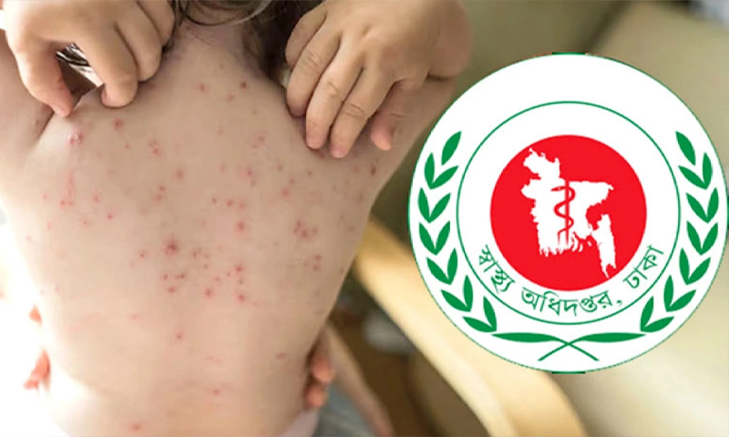 হাম ও হাম সন্দেহে আরও ৫ শিশুর মৃত্যু, আক্রান্ত ১২৭৮