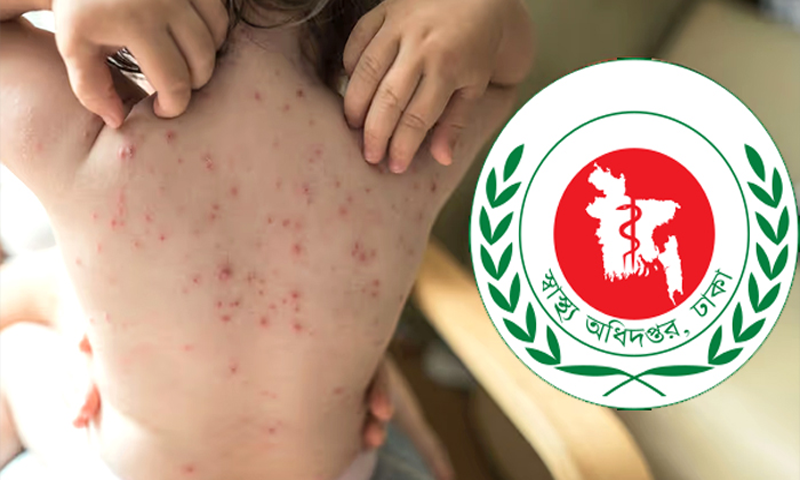  দেশে গত ২৪ ঘণ্টায় হাম ও হামের উপসর্গে আরো ৮ জনের মৃত্যু