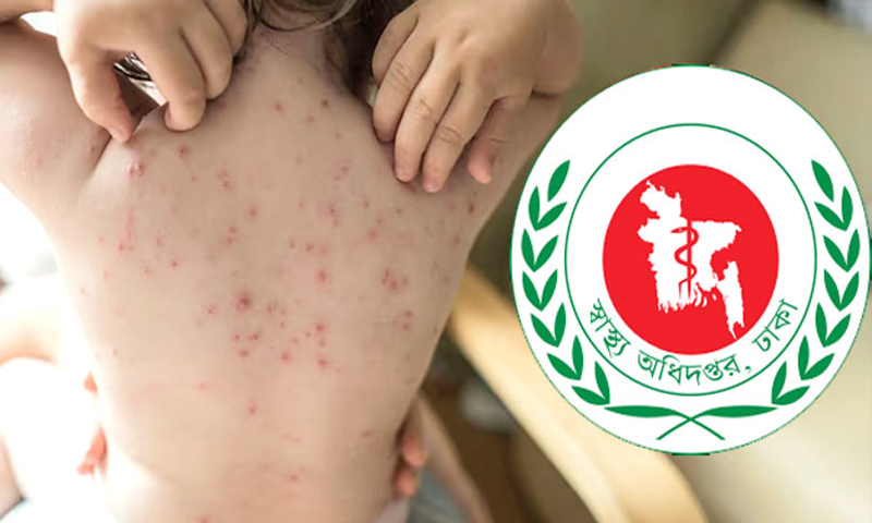  দেশে হাম ও উপসর্গে আরো ৩ শিশুর মৃত্যু